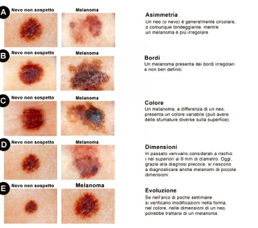 Genetica e Melanoma
