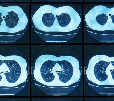 Fibrosi Cistica