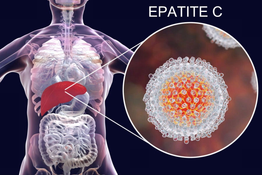 Epatite C (HCV)