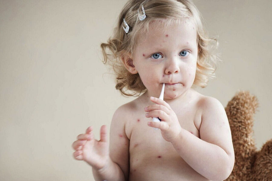 Morbillo