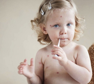 Morbillo