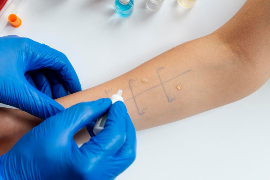 Cosa sono i Test allergologici