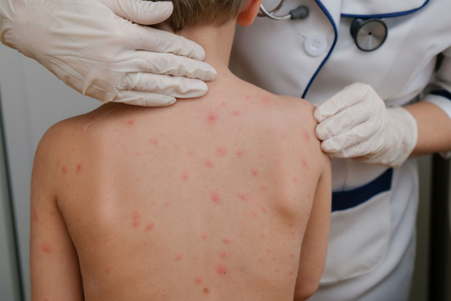 Varicella
