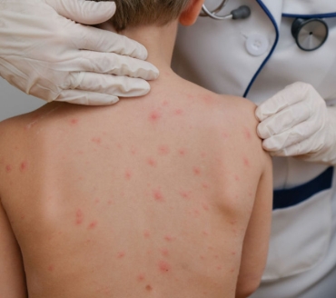 Varicella