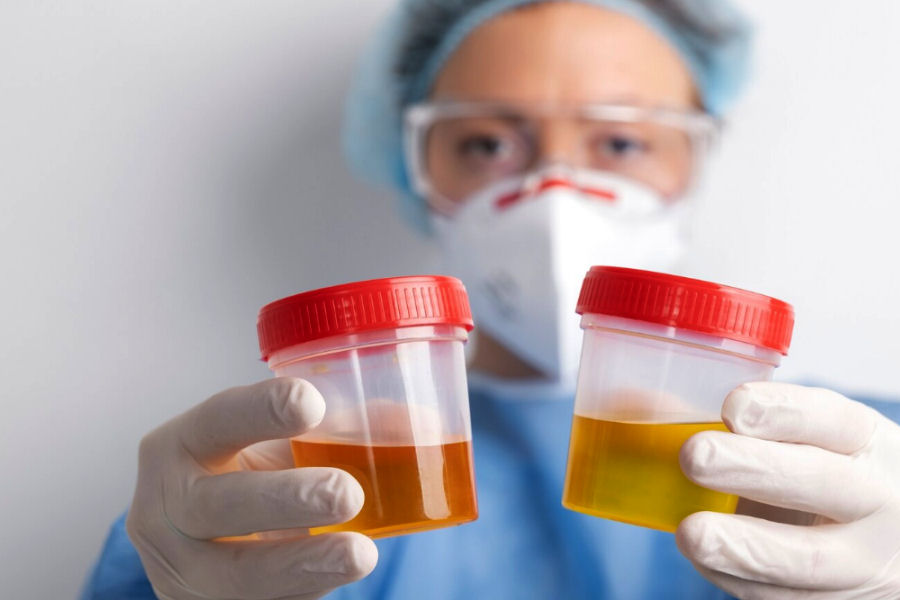 Urinocoltura: cos'è e perché si esegue