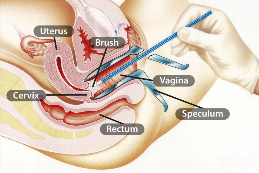 Pap test convenzionale